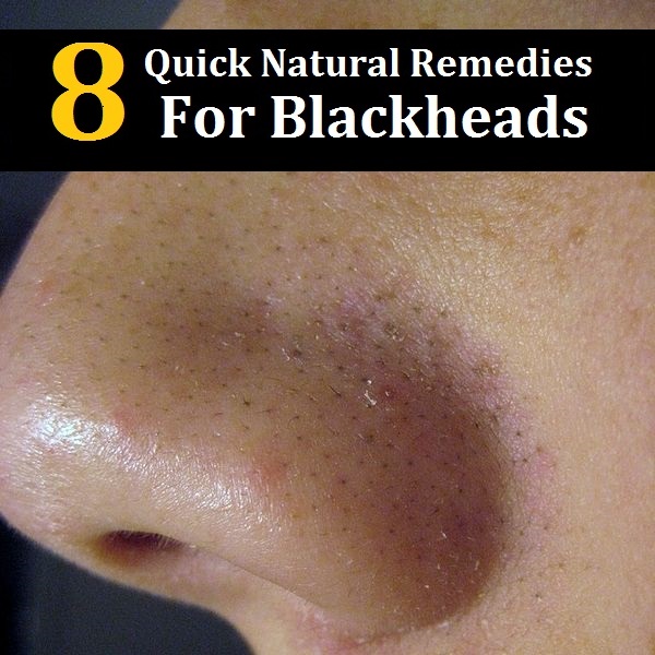 8 Quick Natural Remedies To Get Rid Of Blackheads