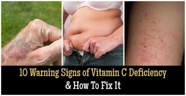 10-warning-signs-of-vitamin-c-deficiency-how-to-fix-it