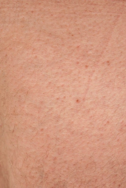 11 Ways To Get Rid of Keratosis Pilaris For Good