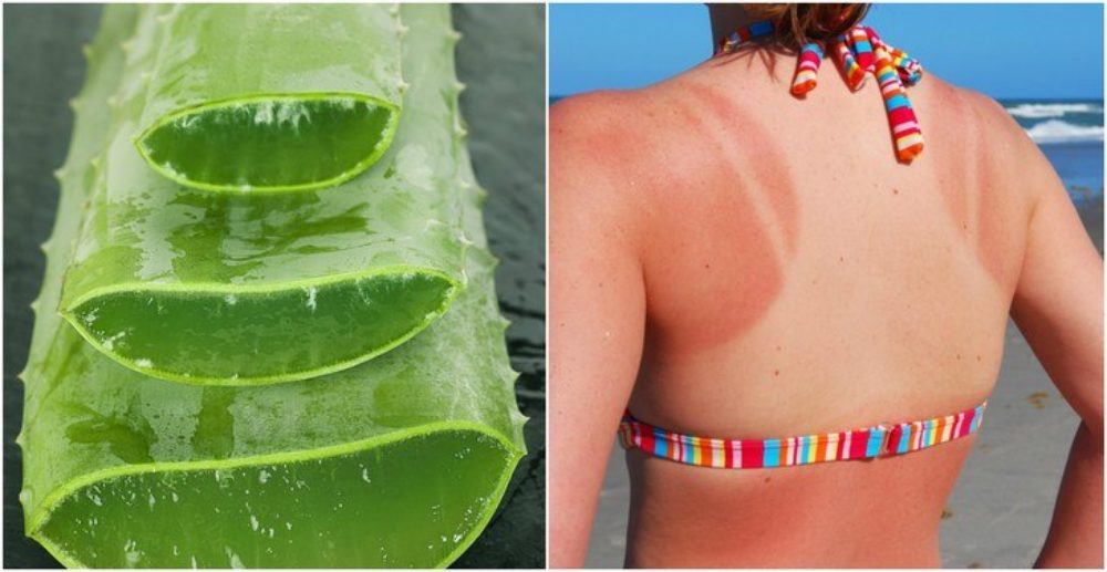 3 Ways To Use Aloe Vera To Heal A Sunburn Fast